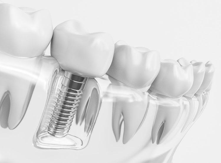 Vorsorgung einer Einzelzahnlücke durch Implantat einer Krone